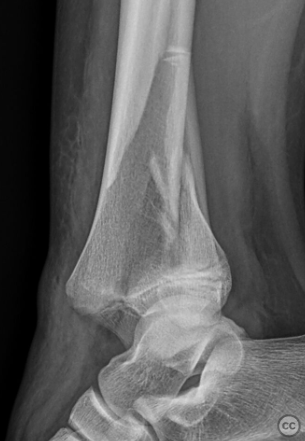 case image