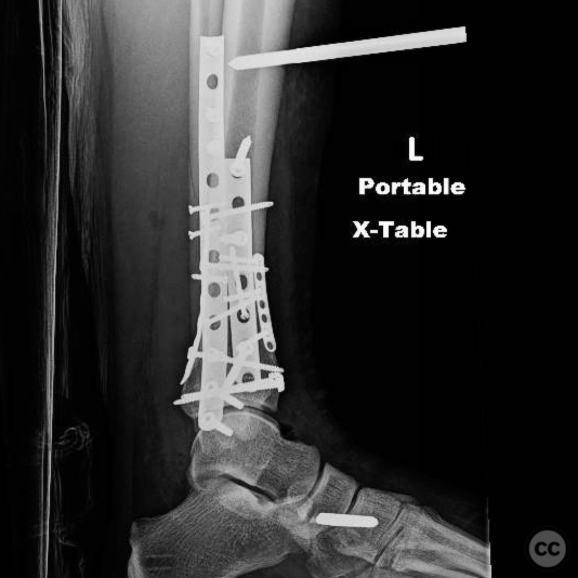 Complex Pilon Fracture with Multiplanar Approach