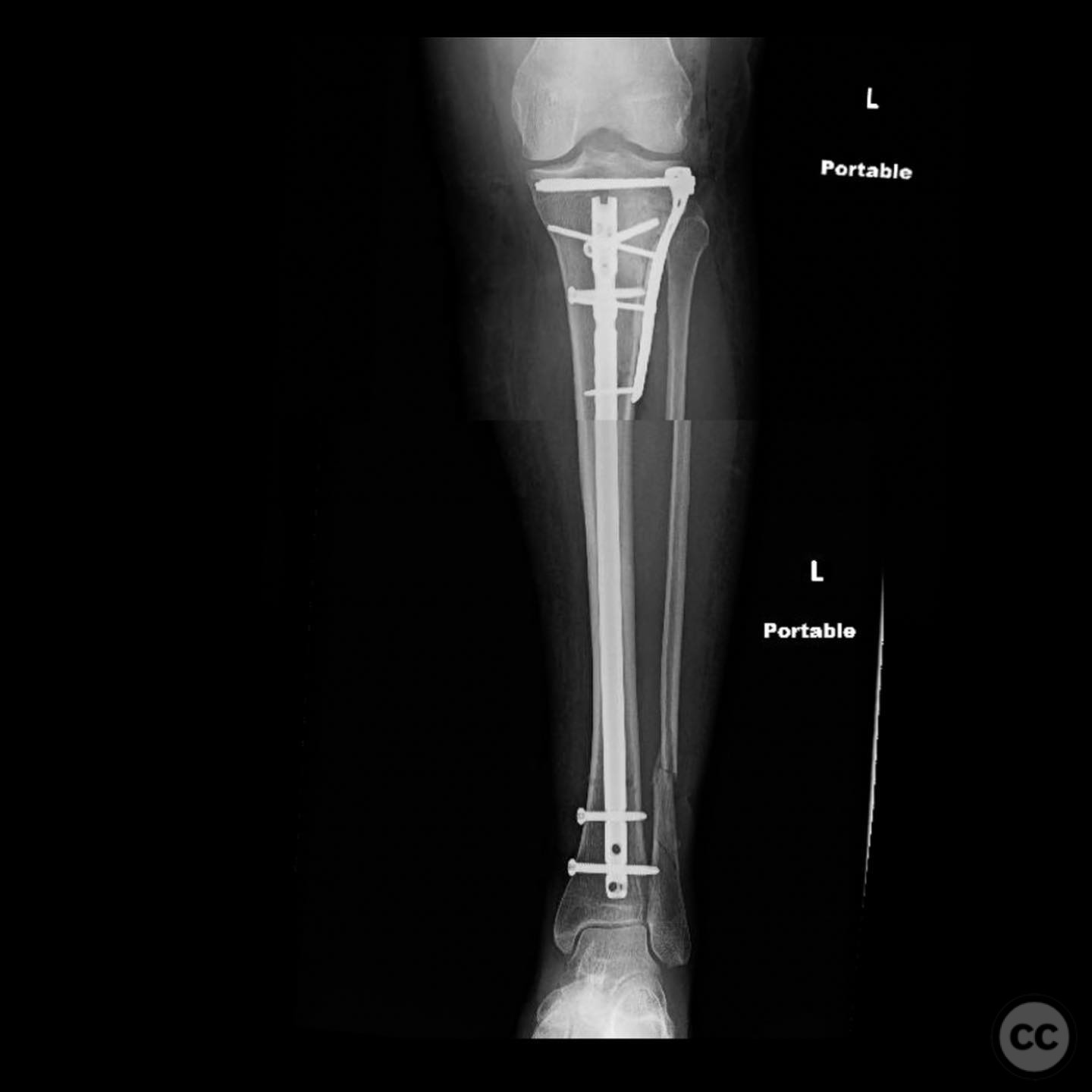 Ipsilateral Tibia AO/OTA 41-B3 Lateral Tibial Plateau Fracture with Ipsilateral Tibial ...
