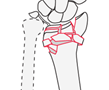 Articular - AO/OTA 2R3B-Cx