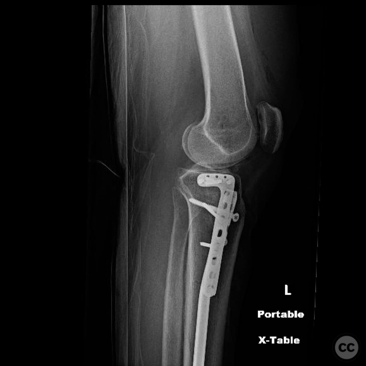 Ipsilateral Tibia AO/OTA 41-B3 Lateral Tibial Plateau Fracture with Ipsilateral Tibial ...